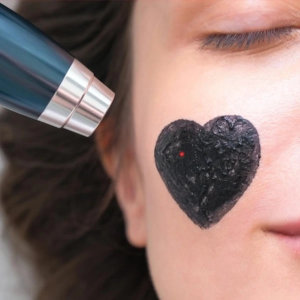 Carbon Peel Facial 1 Benefits of Carbon Peel Facial