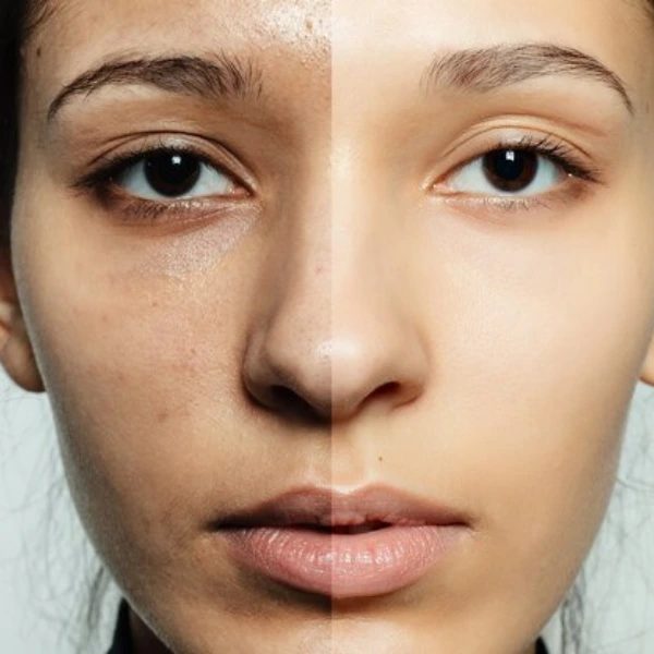 Carbon Peel Facial 4 carbon peel facial in delhi at dua beauty cosmetics the best cosmetologist in delhi