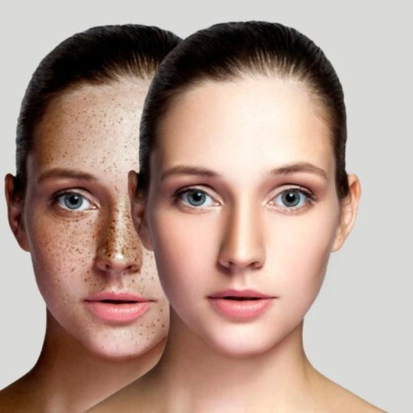 Carbon Peel Facial 2 Carbon Peel Facial in Delhi | Dua Beauty Cosmetics