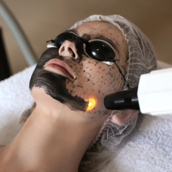 Carbon Laser Facial 2 Carbon Laser Facial – Deep Cleansing & Glow