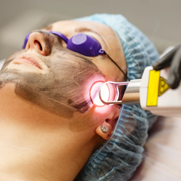 Carbon Laser Facial 1 DBC 70