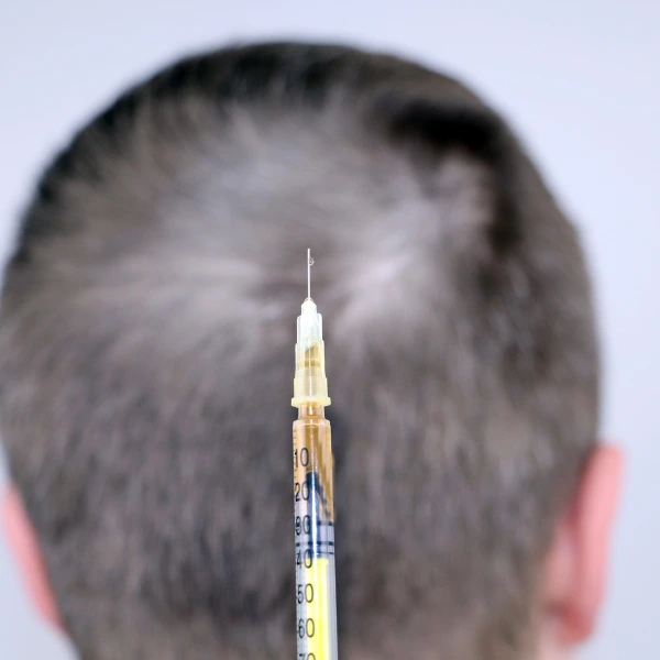 Mesotherapy for Hair 4 Mesotherapy for Hair – Reduce Hair Fall & Boost Growth