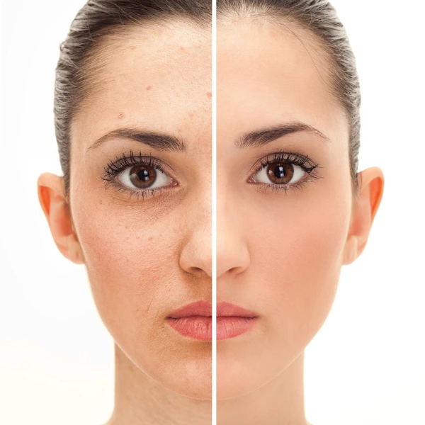 Medi Facial 4 Medi Facial – Advanced Skin Rejuvenation Treatment