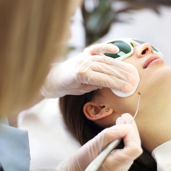 Mole Removal Treatment – Safe & Scar-Free Procedure