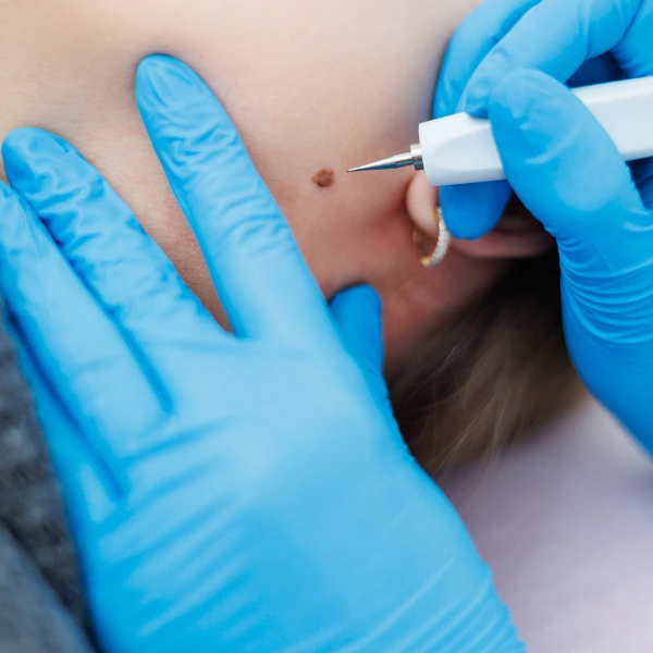 Mole Removal Treatment – Safe & Scar-Free Procedure