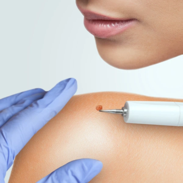 Mole Removal Treatment – Safe & Scar-Free Procedure