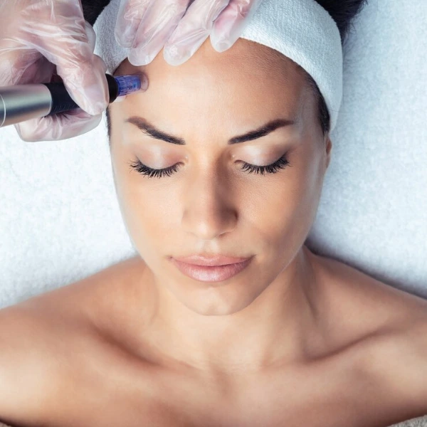 Micro Needling Treatment 4 Micro-Needling Treatment in Delhi – Skin Rejuvenation