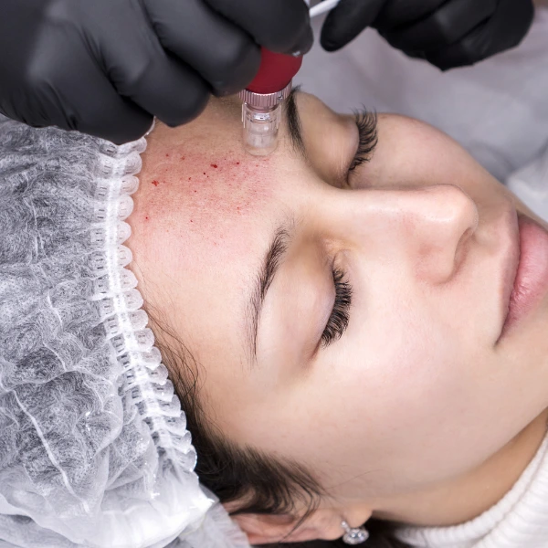 Micro Needling Treatment 3 Micro-Needling Treatment in Delhi – Skin Rejuvenation