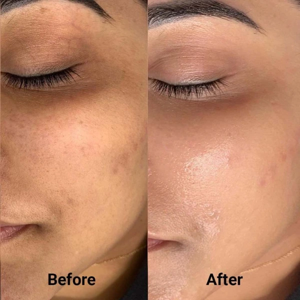 BB Glow Treatment 4 BB Glow Treatment in Delhi – Get Radiant Skin