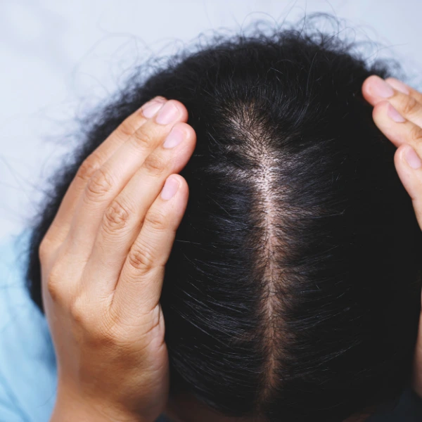 PRP for Hair Loss 1 Regrow stronger, healthier hair with PRP for hair loss at Dua Beauty Cosmetics. Clinically proven, non-surgical treatment by expert specialists in Delhi.