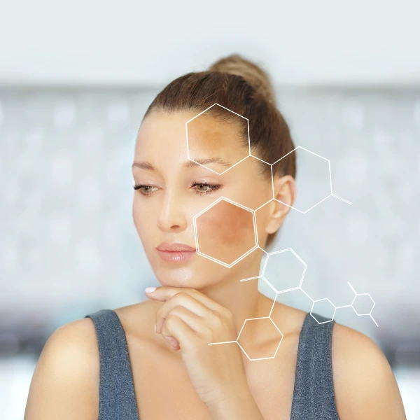 Best Melasma Treatment 3 Best Melasma Treatment in Delhi | Dua Beauty Cosmetics