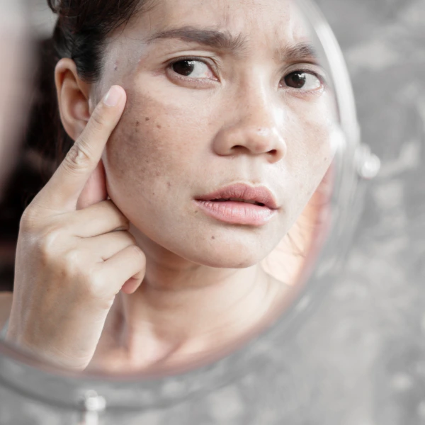 Best Melasma Treatment 4 Best Melasma Treatment in Delhi | Dua Beauty Cosmetics