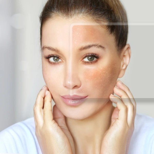 Best Melasma Treatment 1 Get radiant, even-toned skin with the best melasma treatment in Delhi at Dua Beauty Cosmetics. Safe, effective, and customized solutions for all skin types.