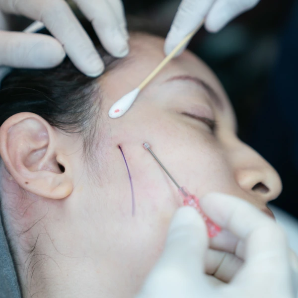 Thread Lifting 3 Thread Face Lift | Non-Surgical Facelift for Youthful Skin
