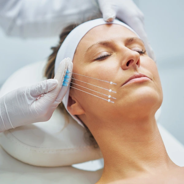 Thread Lifting 4 Thread Face Lift | Non-Surgical Facelift for Youthful Skin